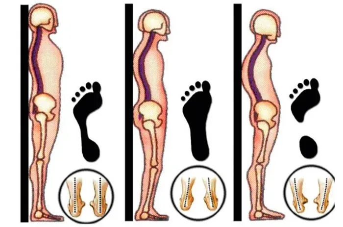 Três perfis posturais em vista lateral, com a pegada e o corte do arco plantar correspondentes
