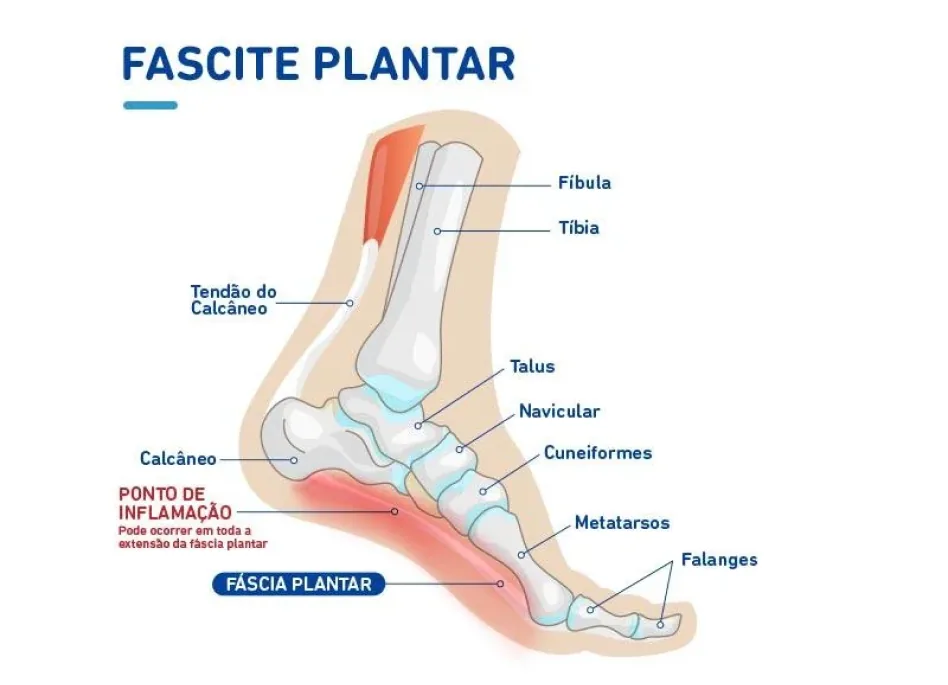 Anatomia da fascite plantar, com o ponto de inflamação na inserção da fáscia no calcâneo