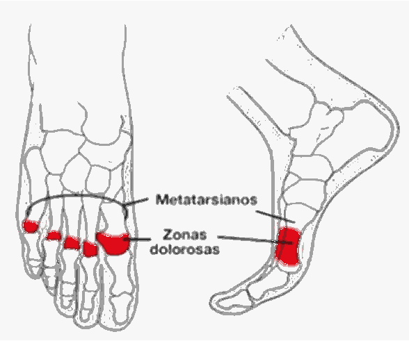Metatarsianos e as zonas dolorosas da metatarsalgia, destacadas em vermelho