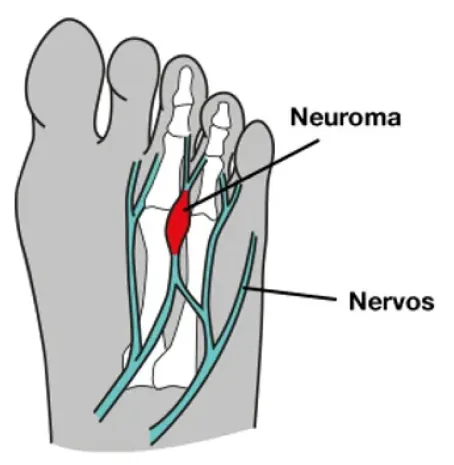 Neuroma de Morton: espessamento do nervo entre os dedos do pé