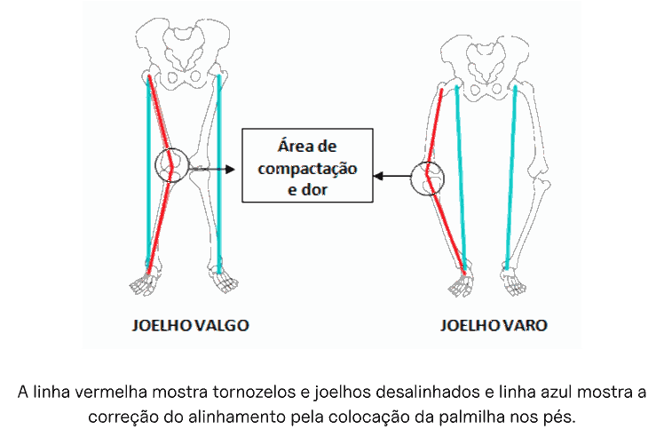 Comparação entre joelho valgo e joelho varo, com a área de compactação e dor assinalada