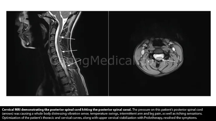 Ressonância magnética da coluna cervical mostrando a compressão da medula dentro do canal espinhal