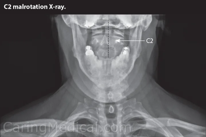 Radiografia mostrando a malrotação da vértebra C2