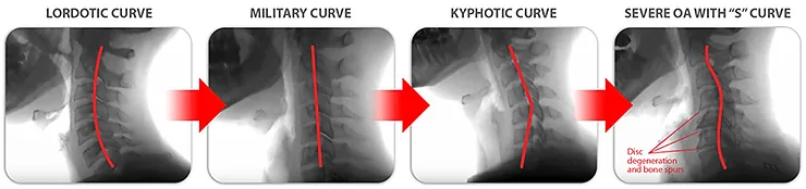 Quatro perfis da curvatura cervical em radiografia: lordótica, militar, cifótica e em S grave