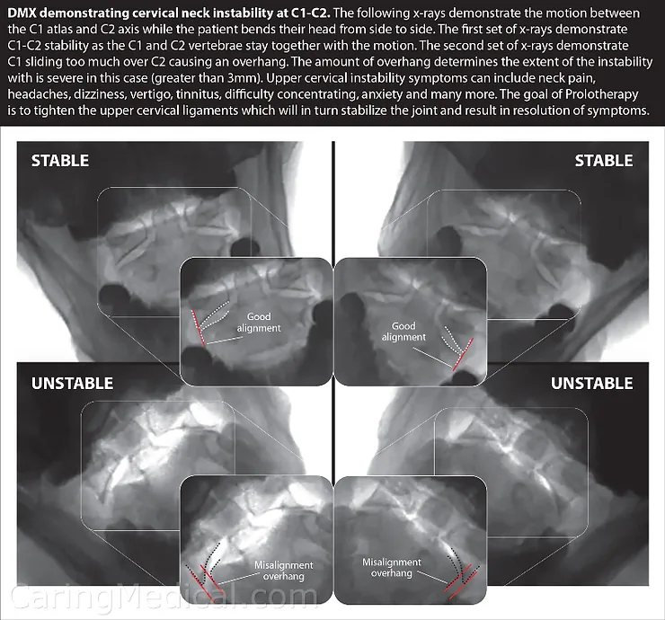 Radiografias dinâmicas comparando a cervical estável e a instável na inclinação lateral da cabeça