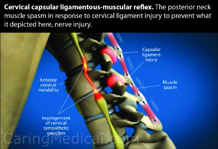 Ilustração do reflexo capsular ligamentar-muscular cervical, com espasmo da musculatura posterior do pescoço