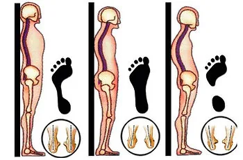 Três perfis posturais em vista lateral, com a pegada e o corte do arco plantar correspondentes