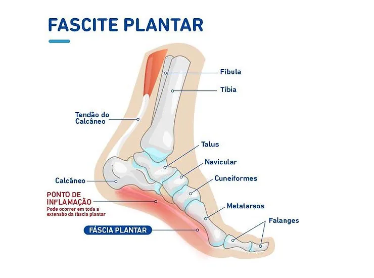 Anatomia da fascite plantar, com o ponto de inflamação na inserção da fáscia no calcâneo
