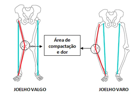 Comparação entre joelho valgo e joelho varo, com a área de compactação e dor assinalada