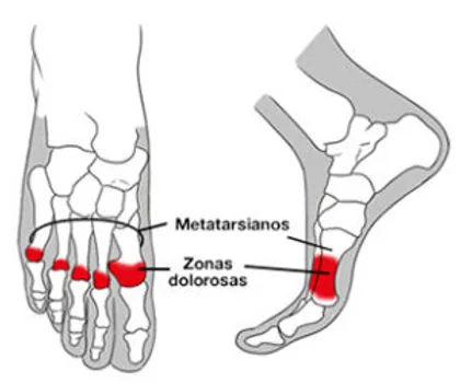 Metatarsianos e as zonas dolorosas da metatarsalgia, destacadas em vermelho