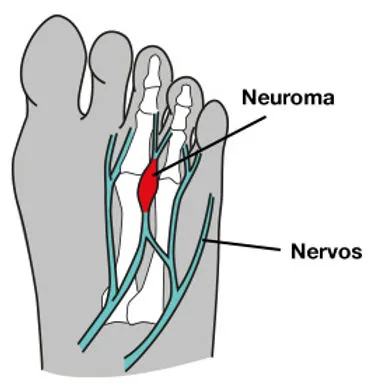Neuroma de Morton: espessamento do nervo entre os dedos do pé