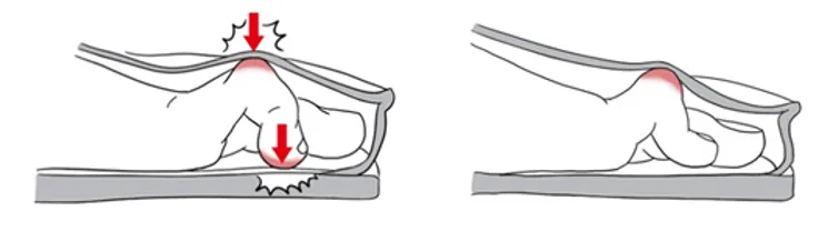 Compressão dos dedos dentro de calçados de bico fino
